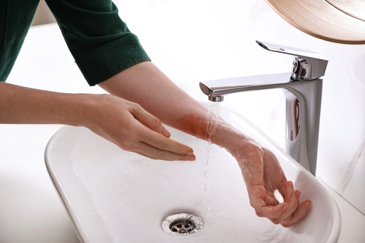 Burn First Aid Guide and Tips