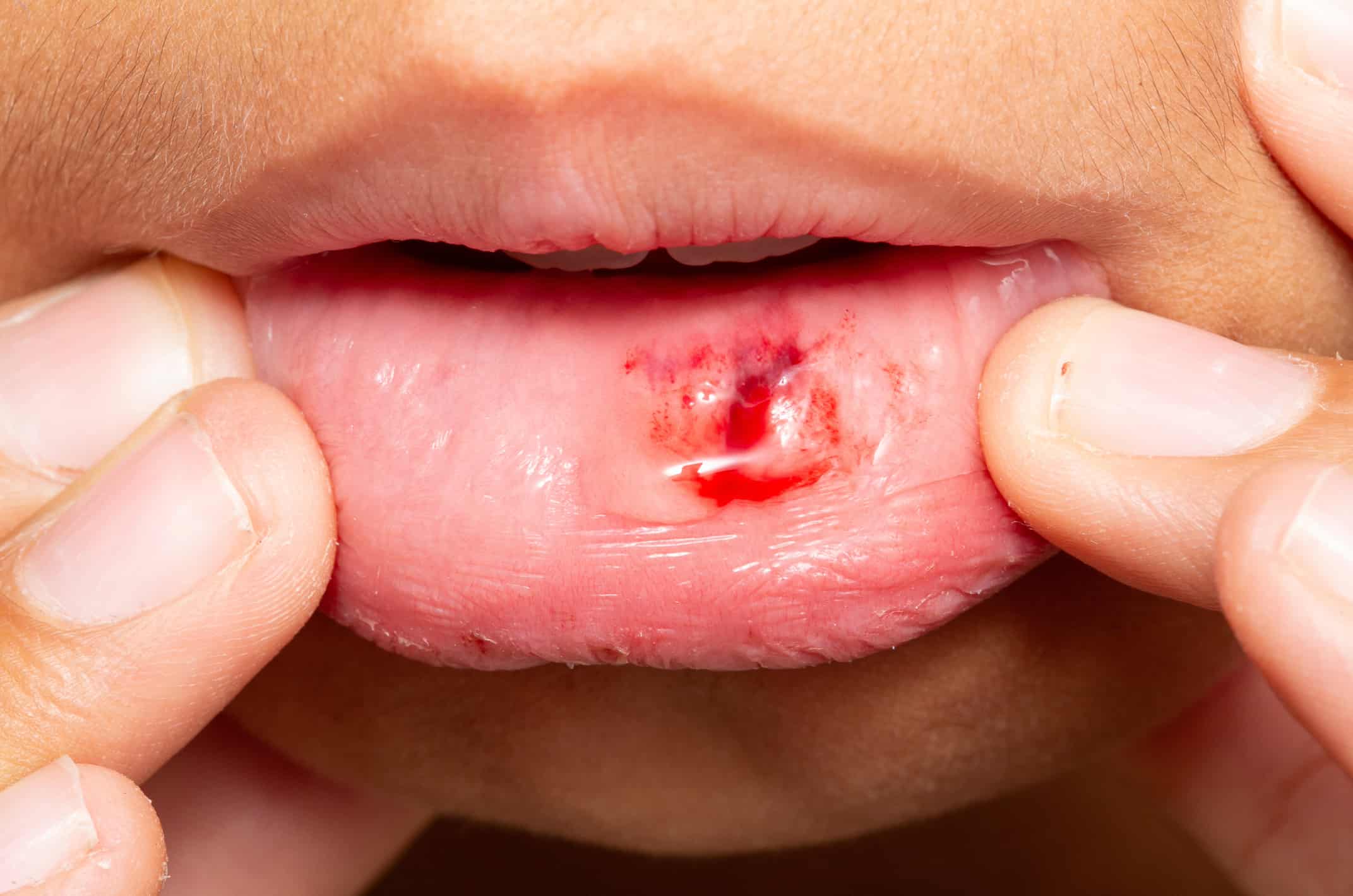 First Aid for Cuts Inside the Mouth