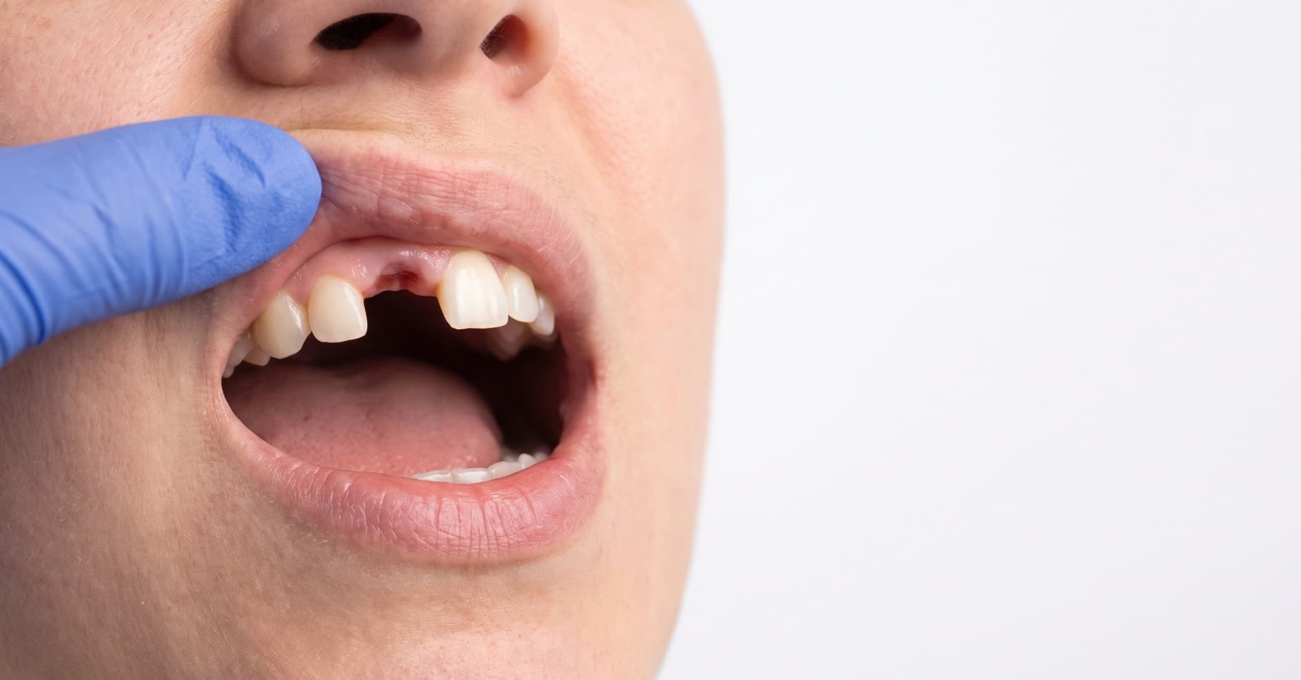 First Aid for Dental Injuries: Broken, Loose and Knocked-Out Teeth